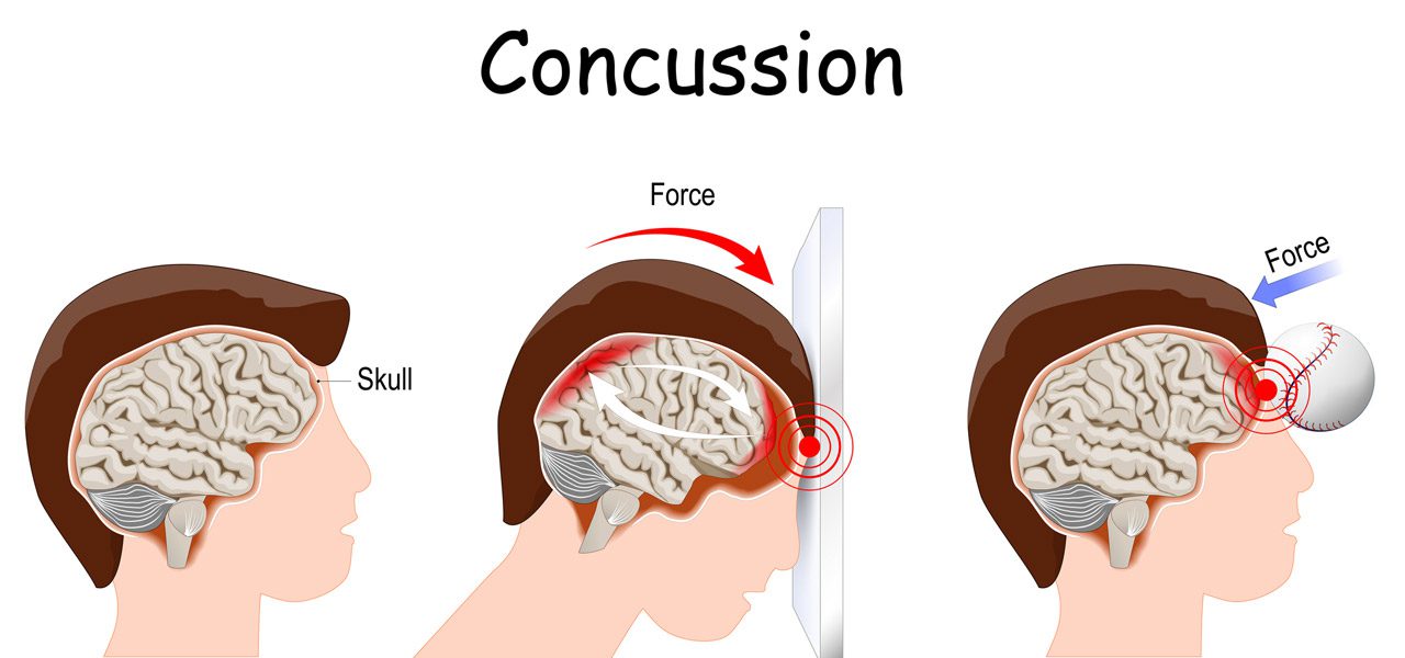 Illustration-of-how-a-concussion-occurs