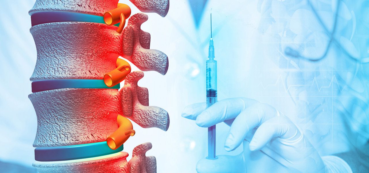 Model-of-a-spine-with-a-physician-in-the-background-holding-a-syringe-used-to-provide-nerve-block